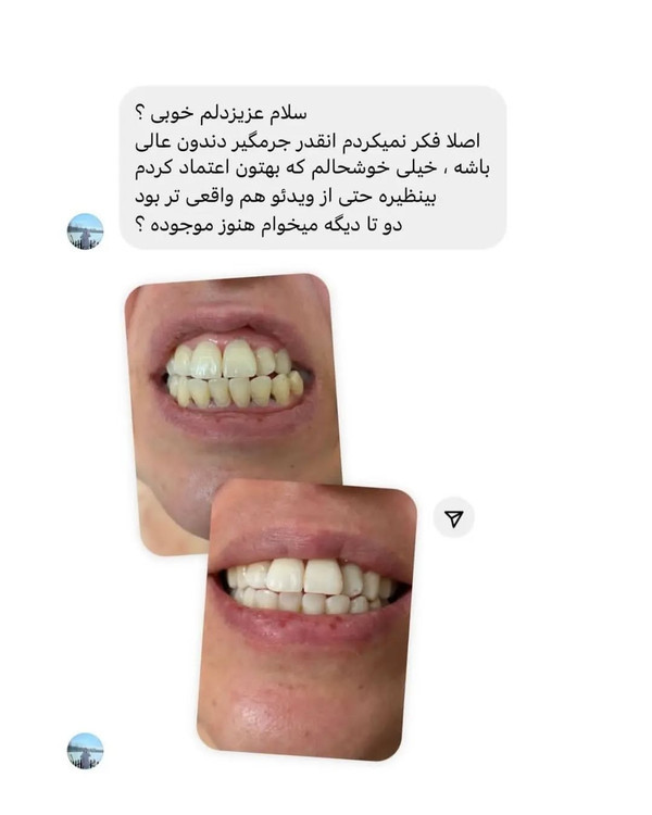 قبل و بعد استفاده از سفید کننده دندان LANBENA